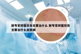 膚專家抑菌軟膏主要治什么 膚專家抑菌軟膏主要治什么皮膚病