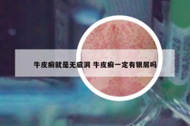 牛皮癬就是無(wú)底洞 牛皮癬一定有銀屑嗎