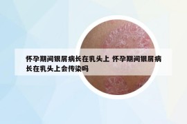 懷孕期間銀屑病長(zhǎng)在乳頭上 懷孕期間銀屑病長(zhǎng)在乳頭上會(huì)傳染嗎
