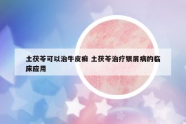 土茯苓可以治牛皮癬 土茯苓治療銀屑病的臨床應(yīng)用