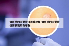 銀屑病的主要特征薄膜現(xiàn)象 銀屑病的主要特征薄膜現(xiàn)象有哪些