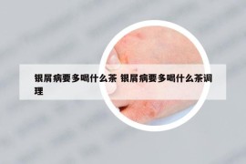 銀屑病要多喝什么茶 銀屑病要多喝什么茶調(diào)理
