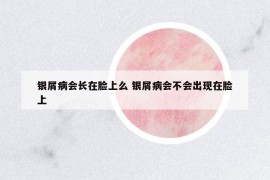 銀屑病會(huì)長(zhǎng)在臉上么 銀屑病會(huì)不會(huì)出現(xiàn)在臉上
