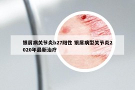 銀屑病關(guān)節(jié)炎b27陽(yáng)性 銀屑病型關(guān)節(jié)炎2020年最新治療