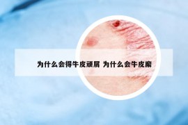 為什么會(huì)得牛皮頑屑 為什么會(huì)牛皮廨