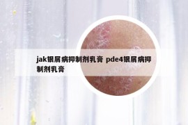 jak銀屑病抑制劑乳膏 pde4銀屑病抑制劑乳膏