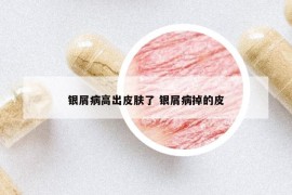 銀屑病高出皮膚了 銀屑病掉的皮