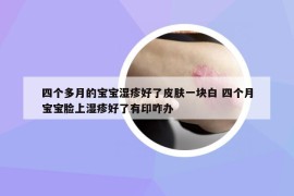 四個(gè)多月的寶寶濕疹好了皮膚一塊白 四個(gè)月寶寶臉上濕疹好了有印咋辦