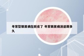 尋常型銀屑病在脫皮了 尋常銀屑病消退期多久