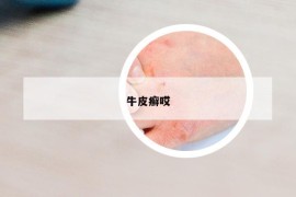 牛皮癬哎