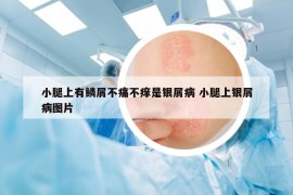 小腿上有鱗屑不痛不癢是銀屑病 小腿上銀屑病圖片