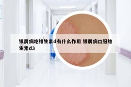 銀屑病吃維生素d有什么作用 銀屑病口服維生素d3