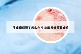 牛皮廨感冒了怎么辦 牛皮廨發(fā)癢是要好嗎