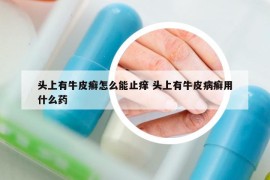 頭上有牛皮癬怎么能止癢 頭上有牛皮病癬用什么藥