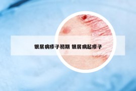 銀屑病疹子初期 銀屑病起疹子