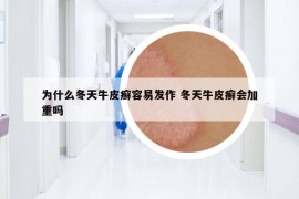 為什么冬天牛皮癬容易發(fā)作 冬天牛皮癬會加重嗎