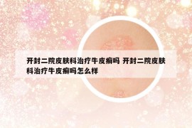 開封二院皮膚科治療牛皮癬嗎 開封二院皮膚科治療牛皮癬嗎怎么樣