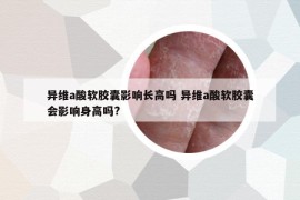 異維a酸軟膠囊影響長高嗎 異維a酸軟膠囊會影響身高嗎?