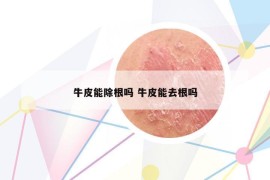 牛皮能除根嗎 牛皮能去根嗎
