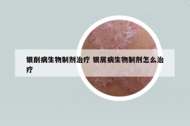 銀削病生物制劑治療 銀屑病生物制劑怎么治療