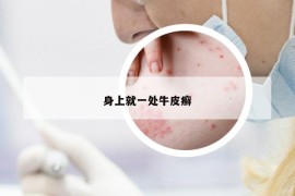 身上就一處牛皮癬