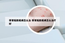 得掌跖膿皰病怎么治 得掌跖膿皰病怎么治療好
