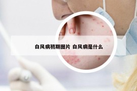 白風病初期圖片 白風病是什么