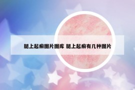 腿上起癬圖片圖庫(kù) 腿上起癬有幾種圖片