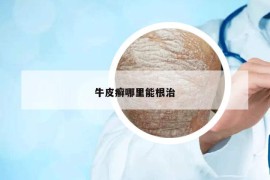 牛皮癬哪里能根治
