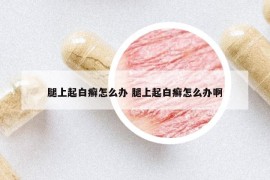 腿上起白癬怎么辦 腿上起白癬怎么辦啊