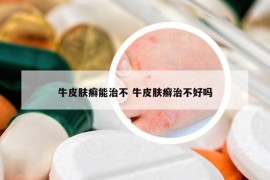 牛皮膚癬能治不 牛皮膚癬治不好嗎