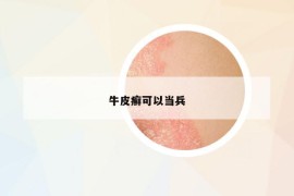 牛皮癬可以當兵