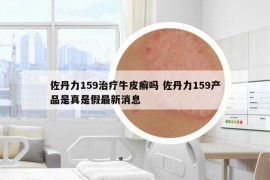 佐丹力159治療牛皮癬嗎 佐丹力159產(chǎn)品是真是假最新消息