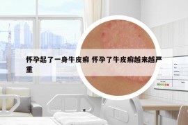 懷孕起了一身牛皮癬 懷孕了牛皮癬越來越嚴(yán)重