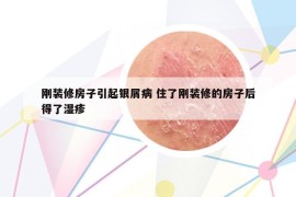 剛裝修房子引起銀屑病 住了剛裝修的房子后得了濕疹