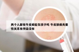 兩個(gè)人都有牛皮癬能生孩子嗎 牛皮膚癬夫妻性關(guān)系有傳染沒(méi)有
