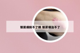 銀屑病除不了跟 銀屑病治不了