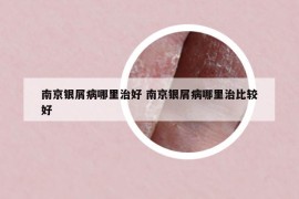 南京銀屑病哪里治好 南京銀屑病哪里治比較好