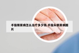 手指銀屑病怎么治療多少錢 手指頭銀屑病圖片