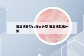 銀屑病分型suffer分型 銀屑病臨床分型