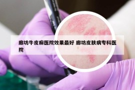 廊坊牛皮癬醫(yī)院效果最好 廊坊皮膚病?？漆t(yī)院