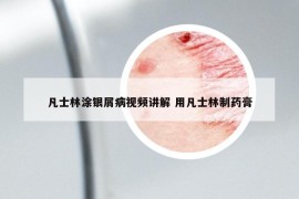 凡士林涂銀屑病視頻講解 用凡士林制藥膏