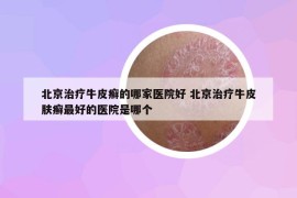 北京治療牛皮癬的哪家醫(yī)院好 北京治療牛皮膚癬最好的醫(yī)院是哪個(gè)