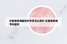 長(zhǎng)春銀屑病醫(yī)院的專家怎么預(yù)約 長(zhǎng)春銀屑病?？漆t(yī)院
