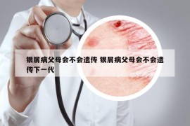 銀屑病父母會(huì)不會(huì)遺傳 銀屑病父母會(huì)不會(huì)遺傳下一代