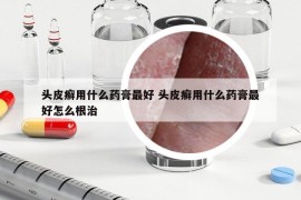 頭皮癬用什么藥膏最好 頭皮癬用什么藥膏最好怎么根治