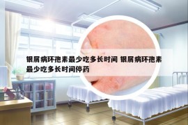 銀屑病環(huán)孢素最少吃多長(zhǎng)時(shí)間 銀屑病環(huán)孢素最少吃多長(zhǎng)時(shí)間停藥