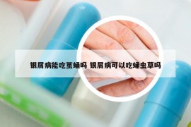 銀屑病能吃繭蛹嗎 銀屑病可以吃蛹蟲草嗎