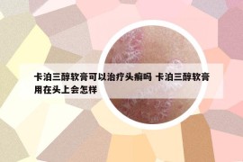 卡泊三醇軟膏可以治療頭癬嗎 卡泊三醇軟膏用在頭上會怎樣