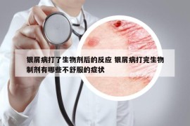 銀屑病打了生物劑后的反應 銀屑病打完生物制劑有哪些不舒服的癥狀